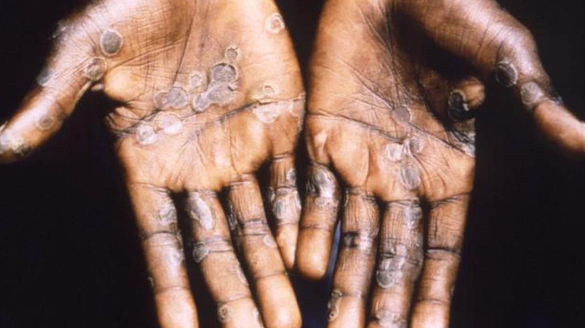 İşte 10 soruda maymun çiçeği hastalığı