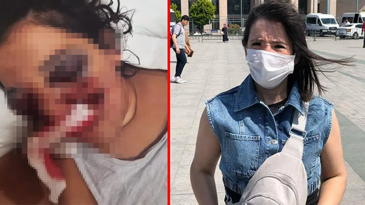 Tatilde ATV'ye bindi, sağ gözünü kaybetti